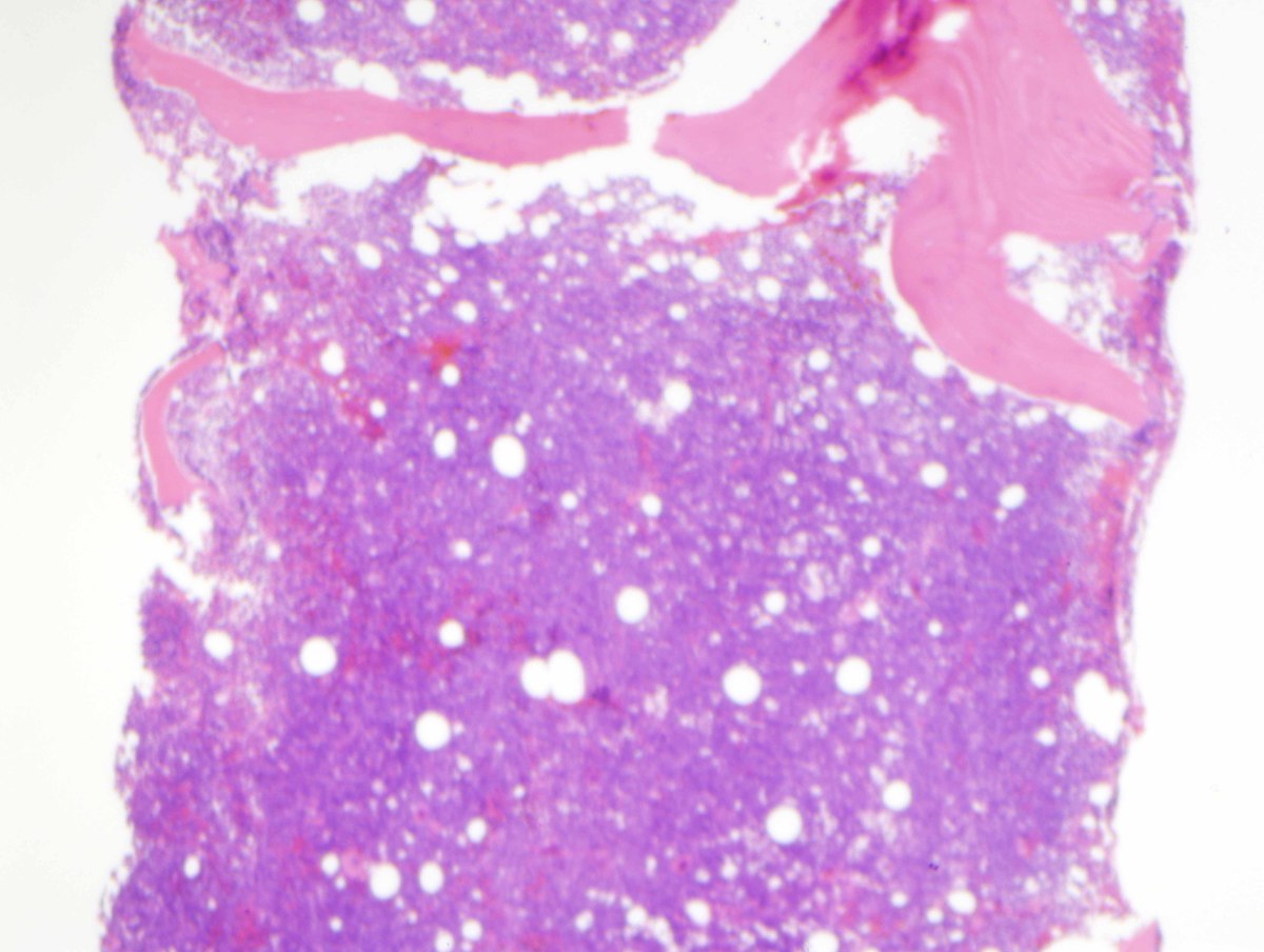 C. Bone marrow core biopsy which is hypercellular and subtotally replaced by sheets of blasts (H&E, 40x).